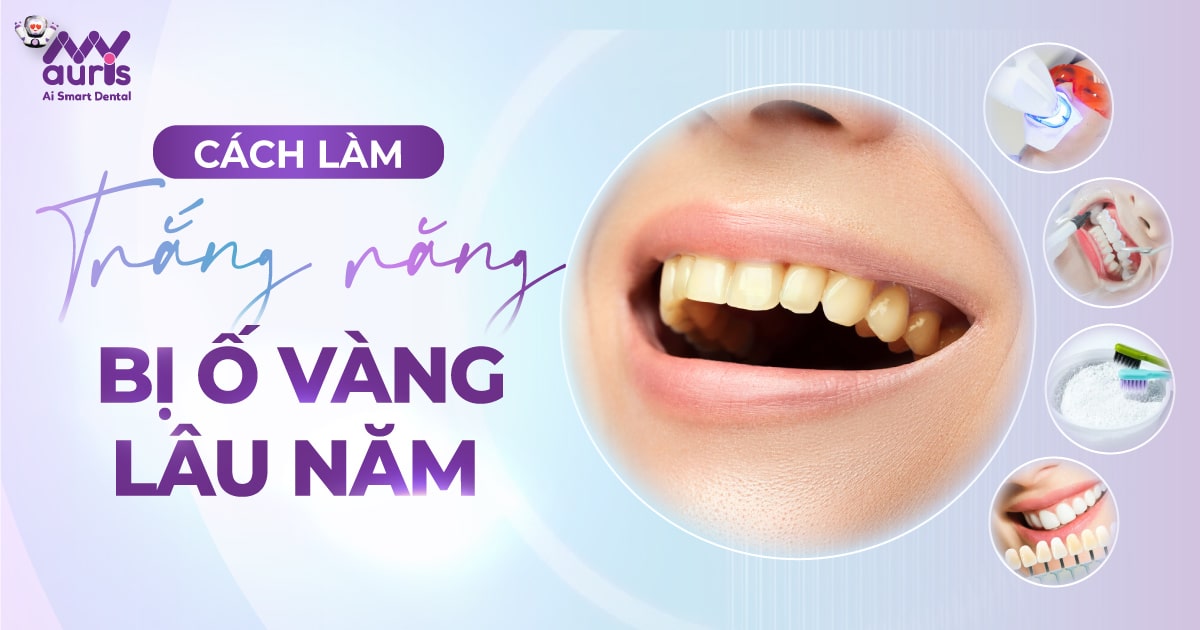 [Giải đáp] Cách làm trắng răng bị ố vàng lâu năm?