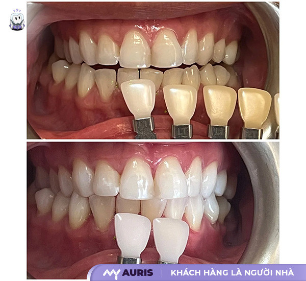 cách làm trắng răng bị ố vàng lâu năm