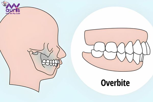 Cách nhận biết răng hô, phân biệt từng tình trạng cụ thể