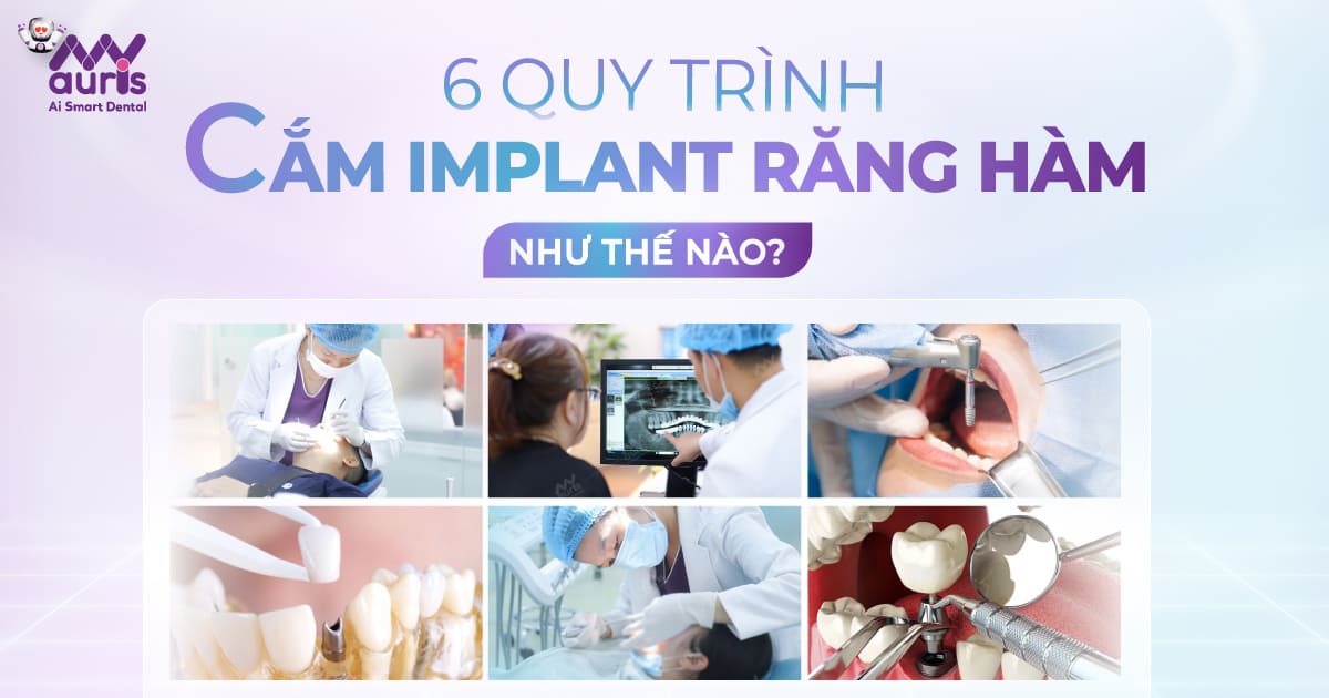 cắm implant răng hàm