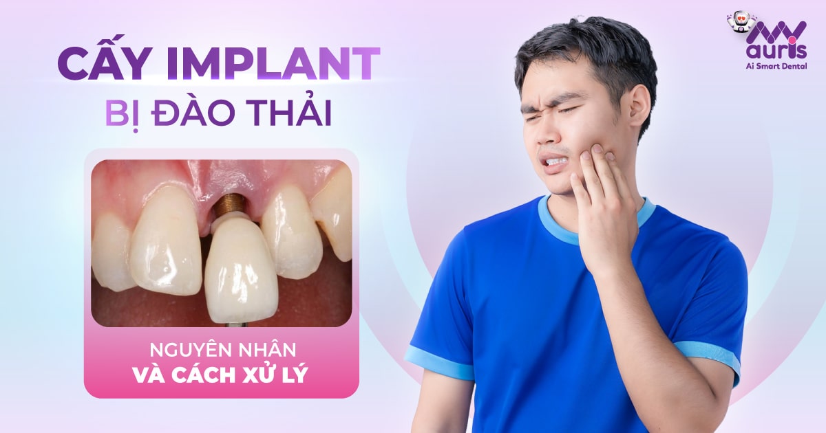 Cấy implant bị đào thải