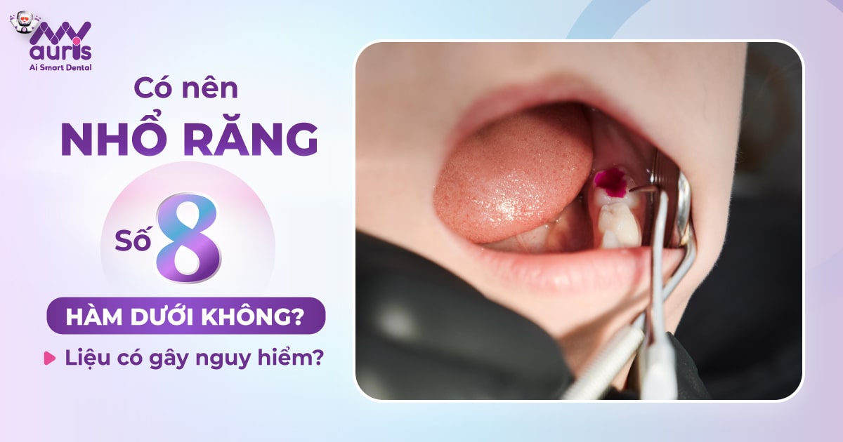 Có nên nhổ răng số 8 hàm dưới không