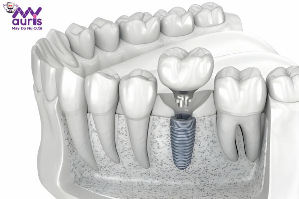Đặt trụ Implant là phương pháp gì?