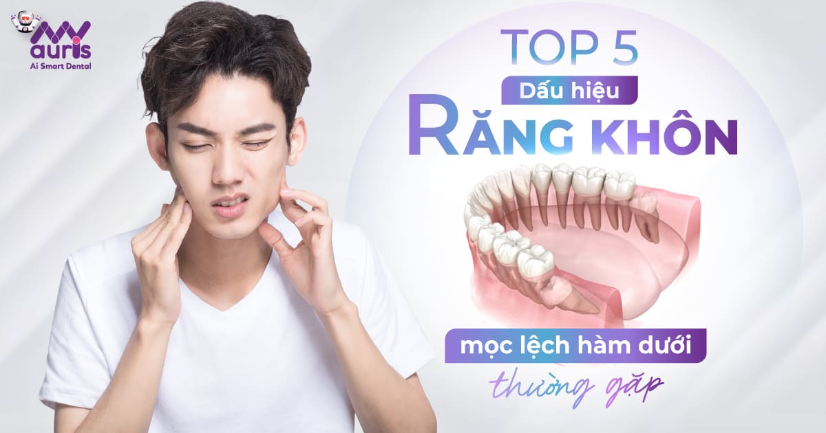 dấu hiệu răng khôn mọc lệch hàm dưới