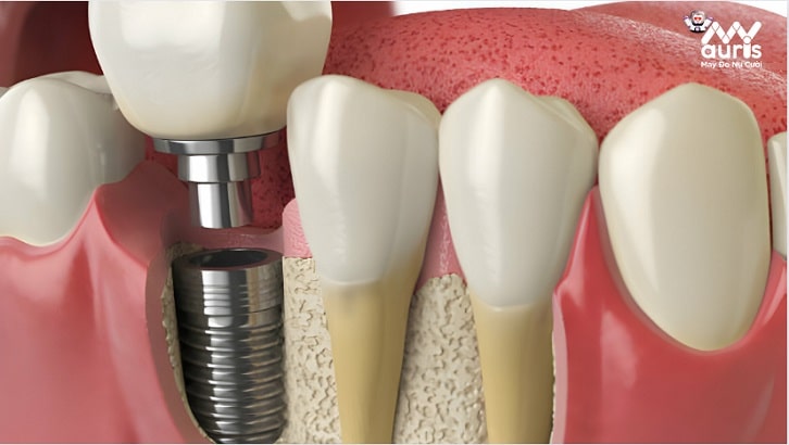điều kiện để trồng răng implant