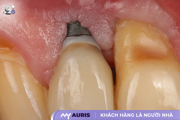 cắm implant bị đào thải,đào thải trụ implant