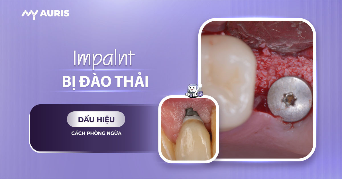 implant-bi-dao-thai-060625-04