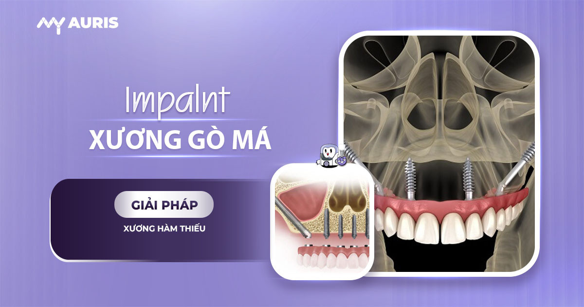 implant gò má,Implant xương gò má