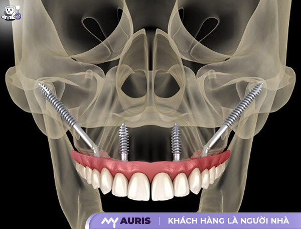 implant-xuong-ham-go-ma-060625-02