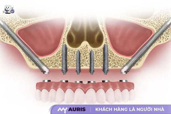 implant-xuong-ham-go-ma-060625-03