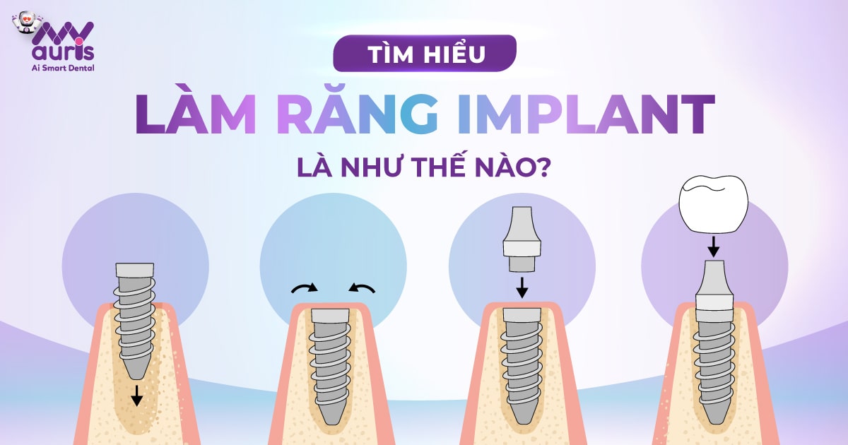 Làm răng Implant là như thế nào? Có đau không?