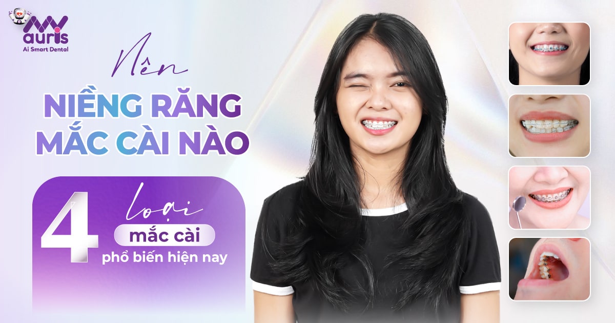 Nên niềng răng mắc cài nào