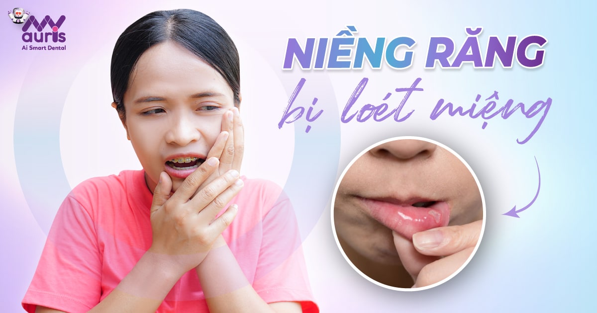 Niềng răng bị loét miệng - 7 lưu ý giúp khắc phục