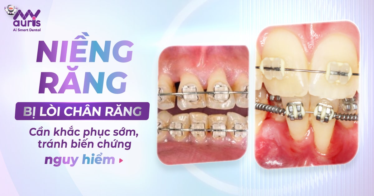 Niềng răng bị lòi chân răng - 4 hậu quả cần lưu ý