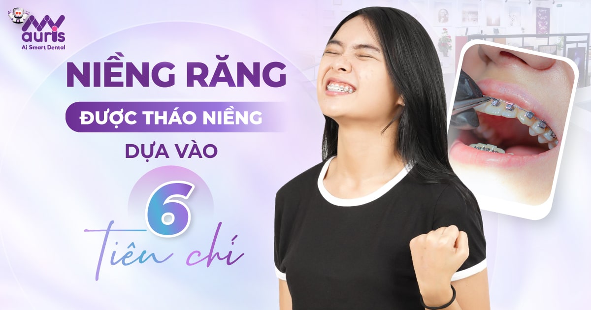 Niềng răng có tháo được không? - Dựa vào 6 tiêu chí