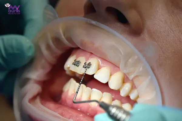 niềng răng đau nhất giai đoạn nào 