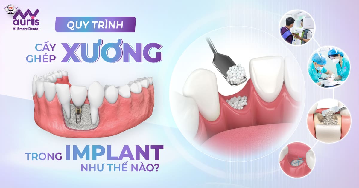 cấy ghép xương trong implant