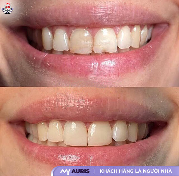 răng sứ orodent,bọc răng sứ orodent có tốt không,răng sứ orodent của nước nào,răng sứ orodent gold