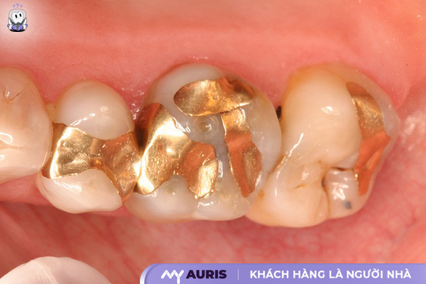 trám răng sâu bao nhiêu tiền,bảng giá trám răng,trám răng sâu giá bao nhiêu,trám răng sâu giá bao nhiêu tiền,trám răng sâu hết bao nhiêu tiền,trám răng thẩm mỹ giá bao nhiêu,giá trám răng sâu