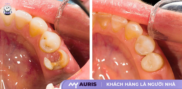 trám răng sâu bao nhiêu tiền,bảng giá trám răng,trám răng sâu giá bao nhiêu,trám răng sâu giá bao nhiêu tiền,trám răng sâu hết bao nhiêu tiền,trám răng thẩm mỹ giá bao nhiêu,giá trám răng sâu