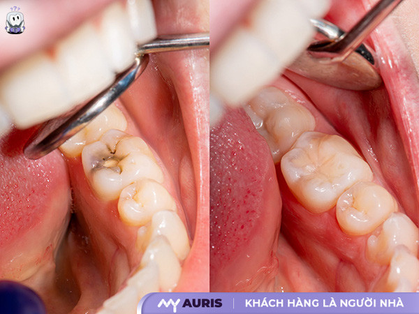 trám răng sâu bao nhiêu tiền,bảng giá trám răng,trám răng sâu giá bao nhiêu,trám răng sâu giá bao nhiêu tiền,trám răng sâu hết bao nhiêu tiền,trám răng thẩm mỹ giá bao nhiêu,giá trám răng sâu