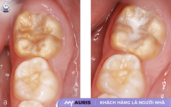 trám răng sâu bao nhiêu tiền,bảng giá trám răng,trám răng sâu giá bao nhiêu,trám răng sâu giá bao nhiêu tiền,trám răng sâu hết bao nhiêu tiền,trám răng thẩm mỹ giá bao nhiêu,giá trám răng sâu