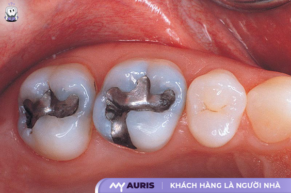 trám răng sâu bao nhiêu tiền,bảng giá trám răng,trám răng sâu giá bao nhiêu,trám răng sâu giá bao nhiêu tiền,trám răng sâu hết bao nhiêu tiền,trám răng thẩm mỹ giá bao nhiêu,giá trám răng sâu