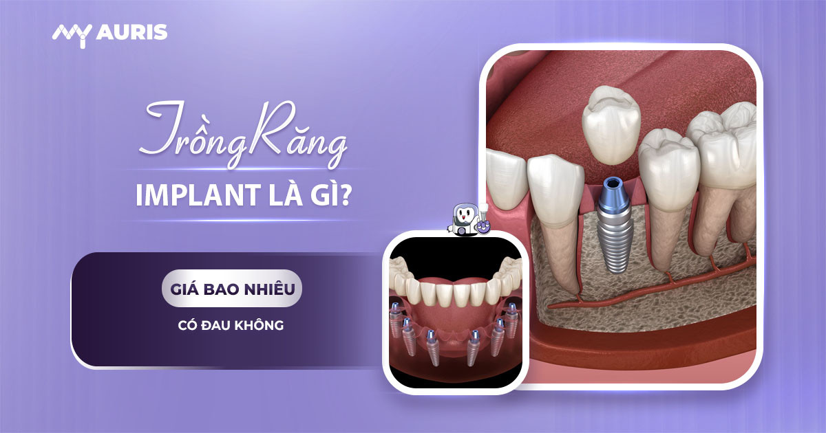 implant,trồng răng implant,răng implant,implant răng,trồng implant,cấy răng implant,implant là gì,implant nha khoa,trong rang implant,cắm răng implant,trồng răng implant là gì,răng implant là gì,làm răng implant,trồng răng implant,implant là gì,implant răng là gì,cắm implant,cấy implant,gắn implant là gì,trồng răng hàm implant,cắm trụ răng,tìm hiểu về trồng răng implant,cấy ghép implant là gì,trồng implant răng hàm,implant nha khoa là gì,cắm implant,cấy răng,làm răng implant là gì,cấy implant là gì,nha khoa implant,cắm implant là gì,gắn implant,