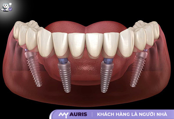 giá cấy ghép implant,implant,trồng răng implant,trụ implant,cấy ghép implant,làm răng implant,implant nha khoa,răng implant,trồng răng,cấy răng implant,giá implant,giá trồng răng implant,trồng răng giá bao nhiêu,trồng răng implant bao nhiêu 1 cái,bảng giá implant,giá trồng implant,giá răng implant