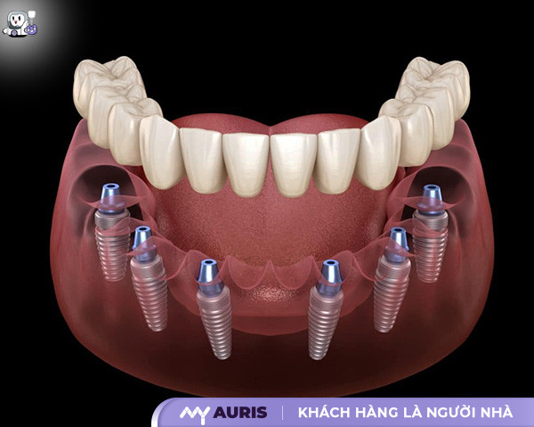 giá cấy ghép implant,implant,trồng răng implant,trụ implant,cấy ghép implant,làm răng implant,implant nha khoa,răng implant,trồng răng,cấy răng implant,giá implant,giá trồng răng implant,trồng răng giá bao nhiêu,trồng răng implant bao nhiêu 1 cái,bảng giá implant,giá trồng implant,giá răng implant