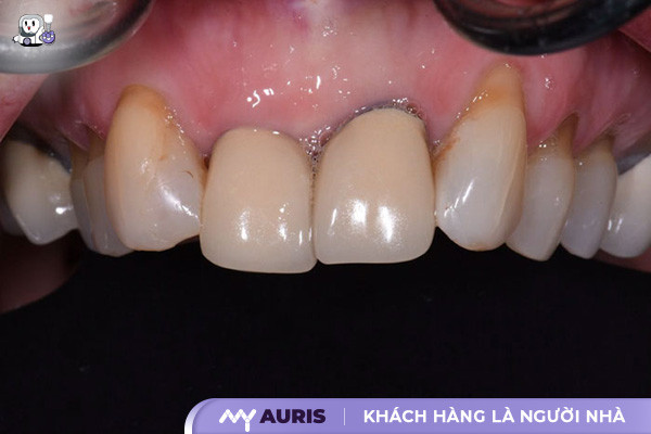 trồng răng sứ bị đau nhức