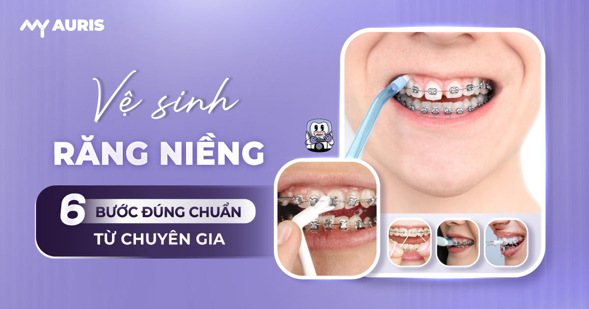vệ sinh răng niềng,vệ sinh răng miệng khi niềng răng
