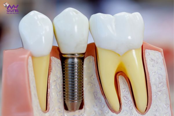  trồng răng implant thất bại 