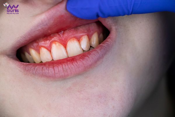 trồng răng implant thất bại 