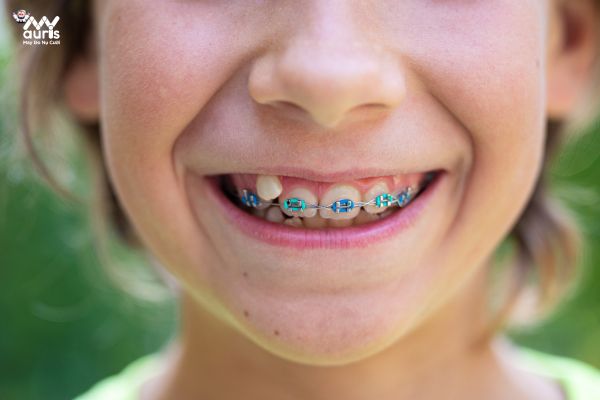 lợi ích và tác hại của niềng răng