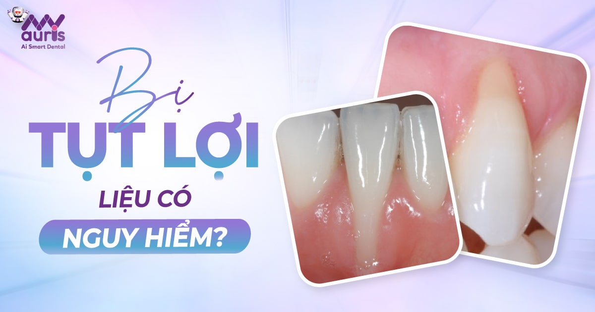 Bị tụt lợi có nguy hiểm không? Điều trị như thế nào?