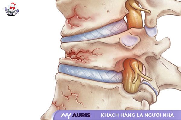 bơm xi măng cột sống,bơm xi măng cột sống được bao lâu,bơm xi măng cột sống hết bao nhiều tiến,đổ xi măng cột sống,chăm sóc bệnh nhân sau bơm xi măng