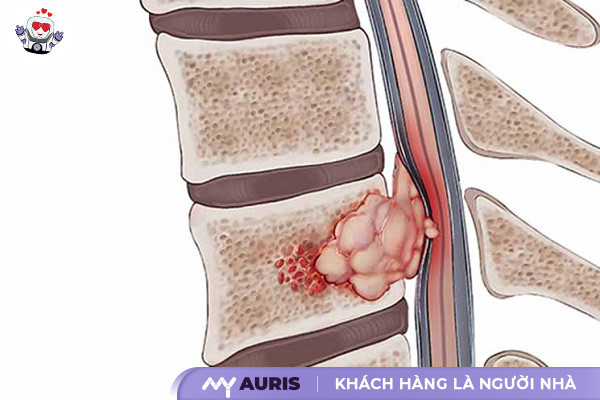 bơm xi măng cột sống,bơm xi măng cột sống được bao lâu,bơm xi măng cột sống hết bao nhiều tiến,đổ xi măng cột sống,chăm sóc bệnh nhân sau bơm xi măng