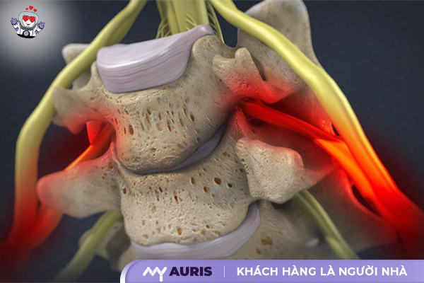 bơm xi măng cột sống,bơm xi măng cột sống được bao lâu,bơm xi măng cột sống hết bao nhiều tiến,đổ xi măng cột sống,chăm sóc bệnh nhân sau bơm xi măng