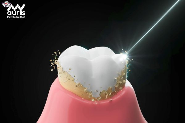 Cạo vôi răng có tốt không? Chia sẻ từ chuyên gia