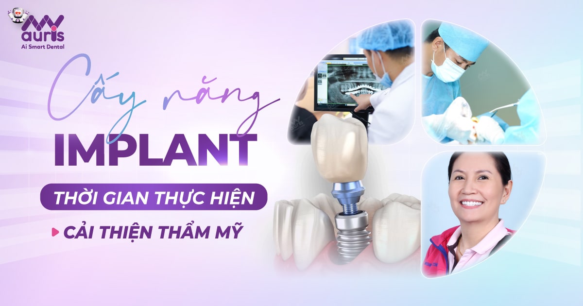 Cấy răng Implant mất bao lâu? - Theo 2 yếu tố chính