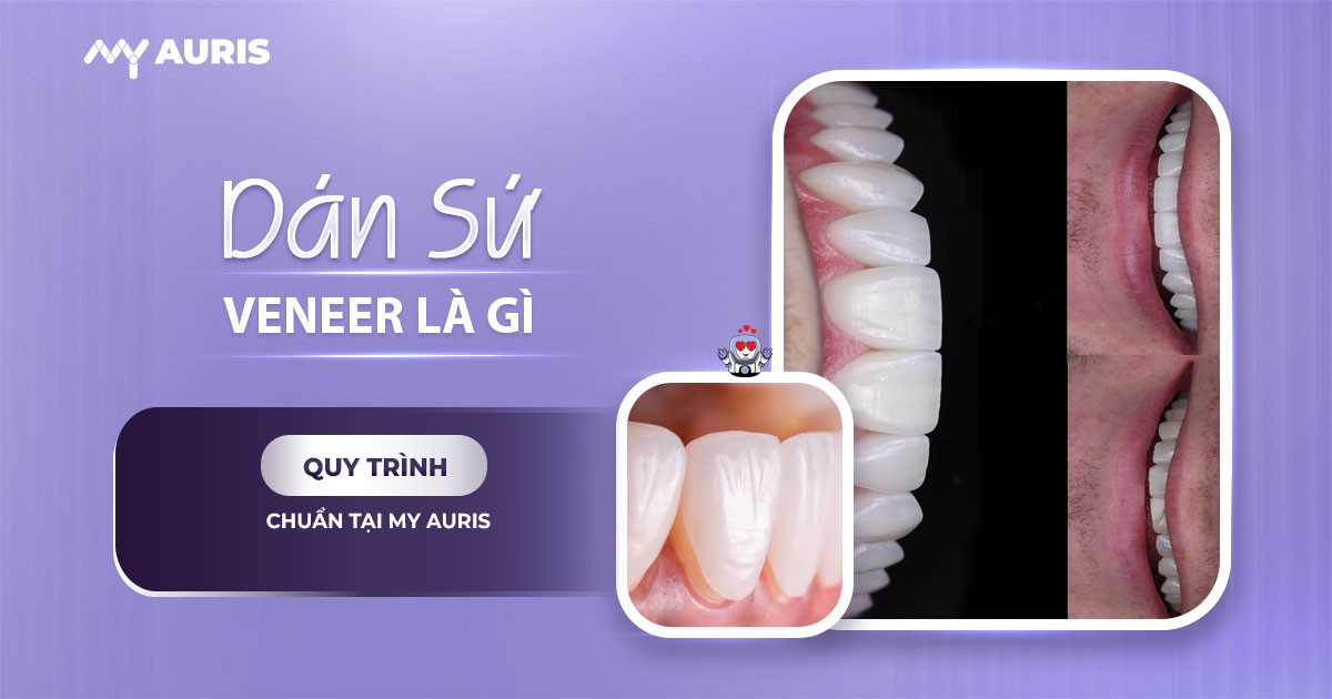 dán sứ Veneer là gì ,mặt dán răng sứ,video dán răng sứ