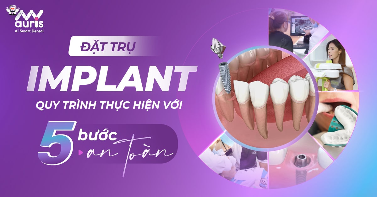 Đặt trụ Implant với quy trình 5 bước thực hiện an toàn