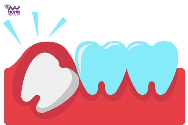  đau răng khôn nên làm gì 
