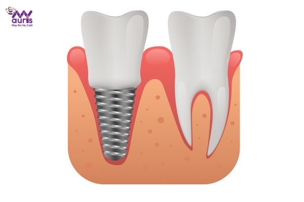 Trồng răng sứ có ảnh hưởng gì không? 