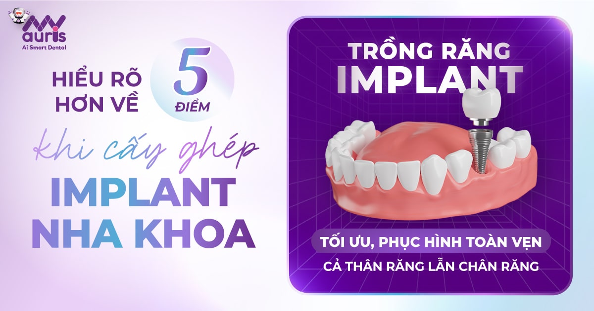 Hiểu rõ hơn về 5 điểm khi cấy ghép implant nha khoa