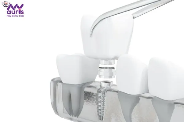 Giải đáp khi nào cần trồng răng Implant?