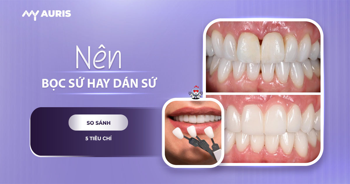 dán veneer và bọc răng sứ cái nào tốt hơn,nên bọc sứ hay dán sứ,dán sứ veneer hay bọc răng sứ