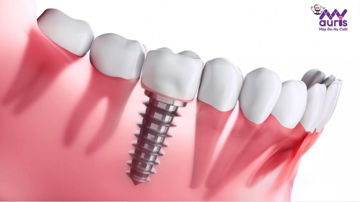 nhổ răng bao lâu thì cắm implant