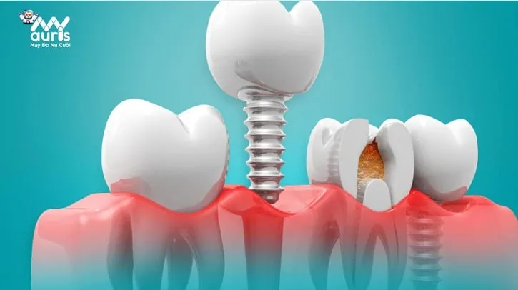 nhổ răng bao lâu thì cắm implant